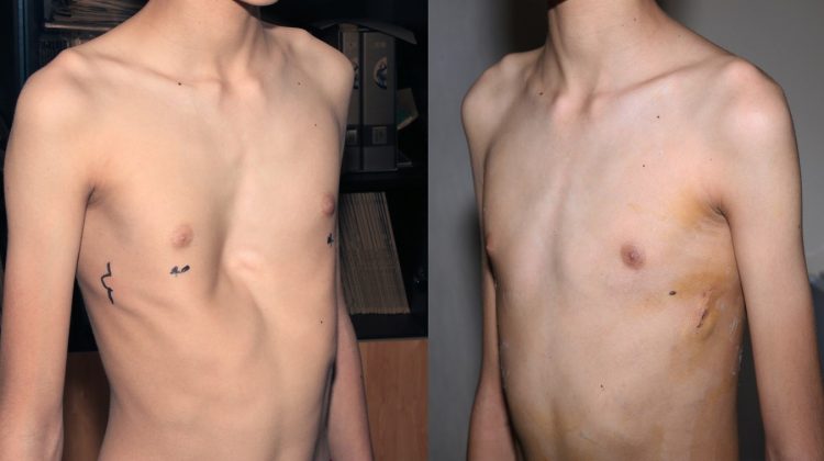 La ce vârstă trebuie să operăm toracele înfundat- pectus excavatum???